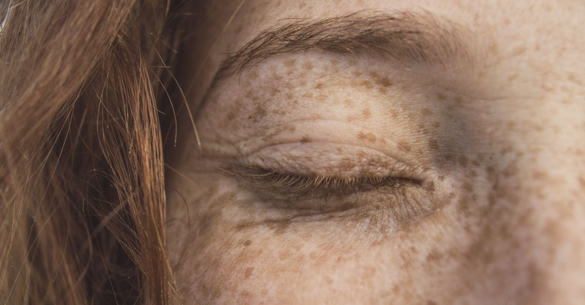 Macchie di Melasma sul Viso: Rimedi Efficaci e Strategie Quotidiane per una Pelle Più Uniforme