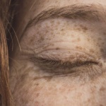 Macchie di Melasma sul Viso: Rimedi Efficaci e Strategie Quotidiane per una Pelle Più Uniforme